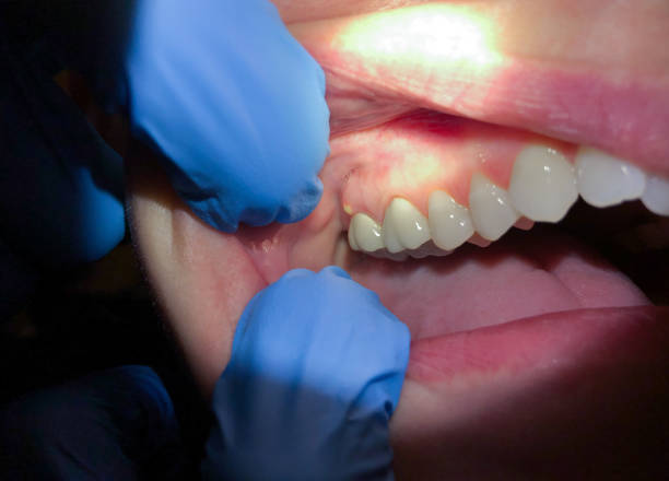 Best Broken or Cracked Tooth Emergency Dentist in Upper Sandusky, OH