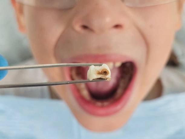 Best Emergency Dentist for Lost Fillings or Crowns in Upper Sandusky, OH